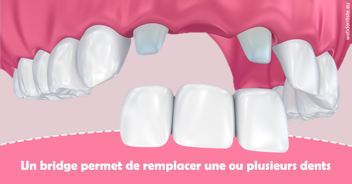 https://dr-pensa-sandra.chirurgiens-dentistes.fr/Bridge remplacer dents 2
