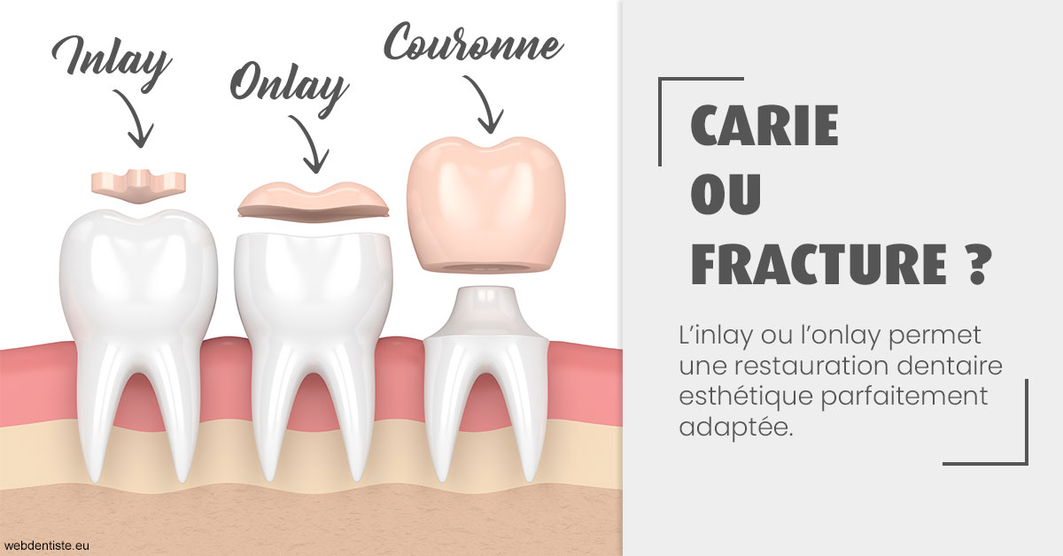 https://dr-pensa-sandra.chirurgiens-dentistes.fr/T2 2023 - Carie ou fracture 1