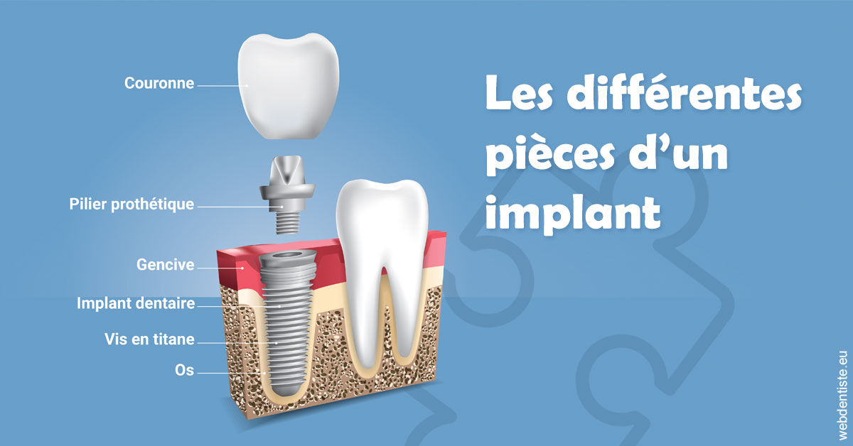 https://dr-pensa-sandra.chirurgiens-dentistes.fr/Les différentes pièces d’un implant 1
