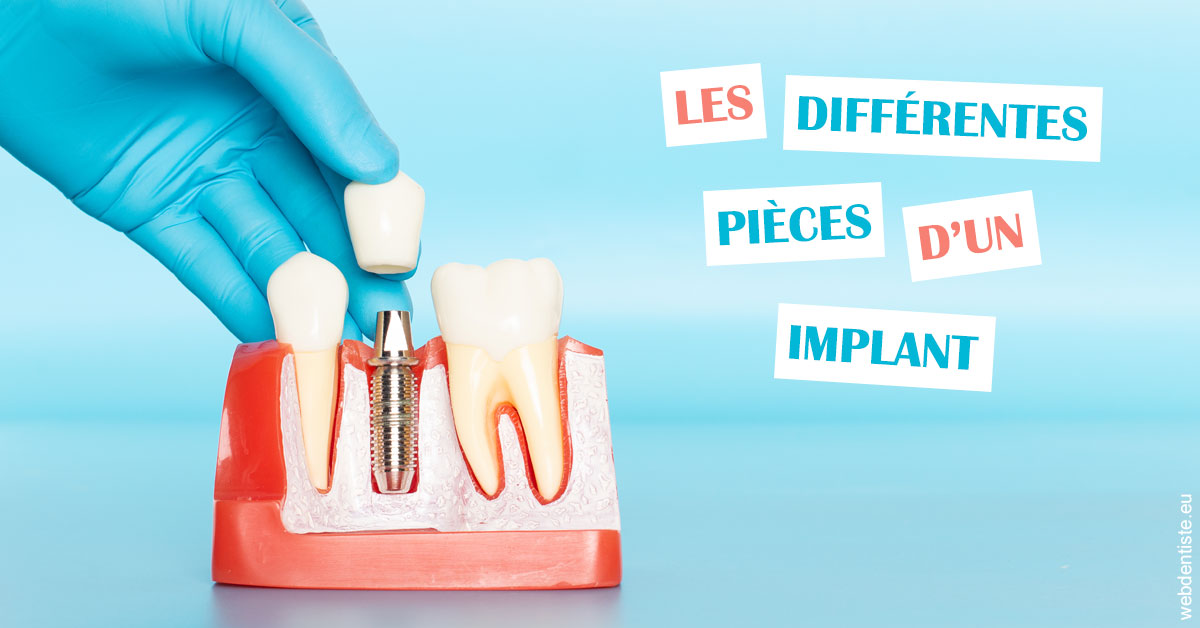https://dr-pensa-sandra.chirurgiens-dentistes.fr/Les différentes pièces d’un implant 2