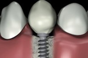 Les implants dentaires